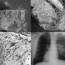 آزبست، Asbesto آزبست، Asbesto